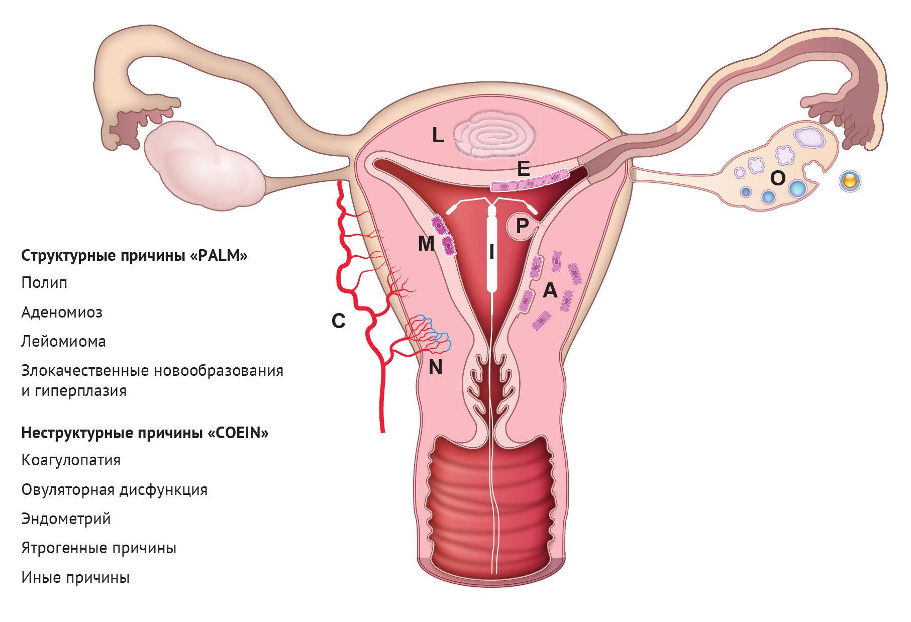 Миома матки и гиперплазия эндометрия – что это, причины, симптомы и признаки, диагностика и лечение миомы и гиперплазии эндометрия в москве