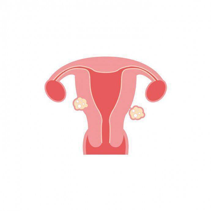 миома матки и гиперплазия эндометрия
