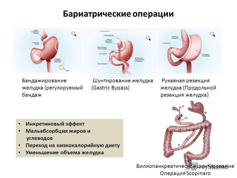 Питание после бариатрической операции | фнкц фмба россии