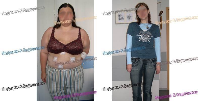 Урезать желудок — не выход: истории людей, набравших вес после бариатрической операции
