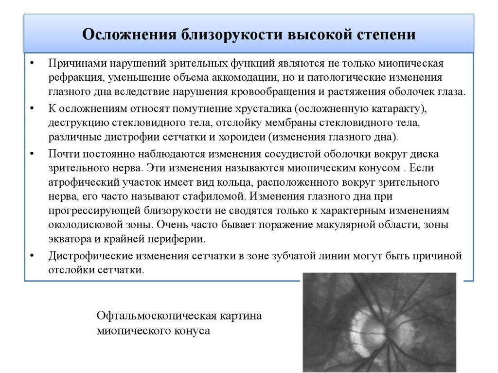 Имплантация факичных интраокулярных линз для лечения близорукости (миопии) высокой - клиника микрохирургии глазастепени