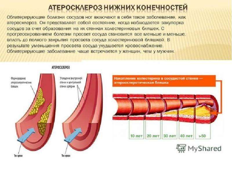 Атеросклероз сосудов нижних конечностей. оаснк – облитерирующий атеросклероз