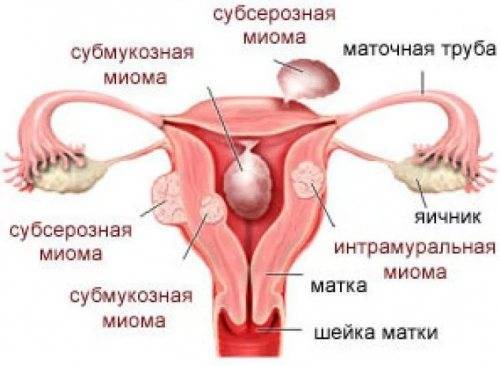 Миома матки и гиперплазия эндометрия – что это, причины, симптомы и признаки, диагностика и лечение миомы и гиперплазии эндометрия в москве