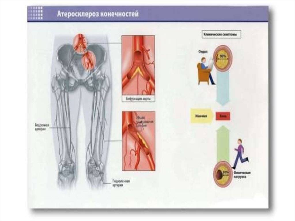 Атеросклероз сосудов ног: лечение атеросклероза