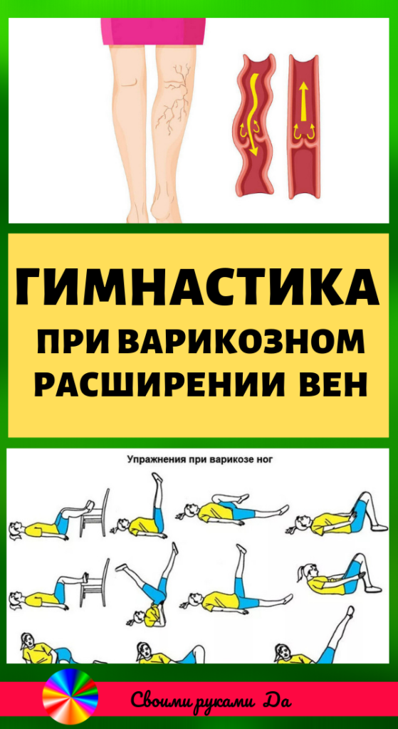 Запреты при варикозе ног (нижних конечностей)