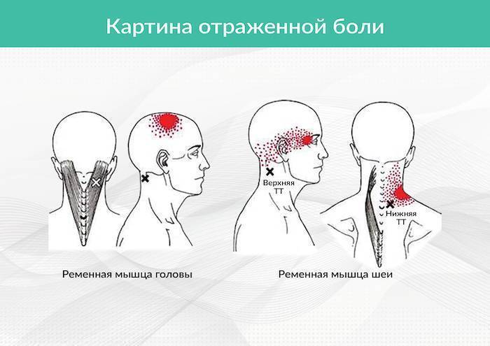 Ременная мышцы: когда болит голова и шея
