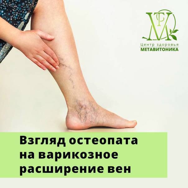 Варикоз нижних конечностей: лечение, причины и симптомы варикозного расширения вен ног