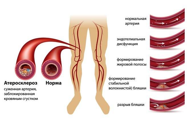 Облитерирующий атеросклероз сосудов нижних конечностей | болезни артерий | сосудистый центр им. т.топпера