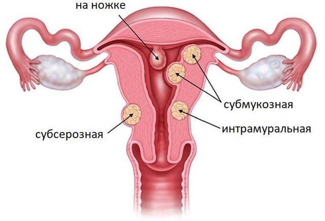 Атрофический вагинит - подробно о лечении атрофического вагинита в постменопаузе у женщин