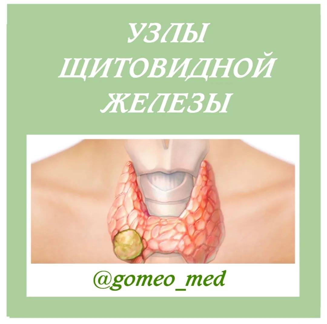 Узлы щитовидной железы. причины, симптомы, признаки, диагностика и лечение патологии :: polismed.com
