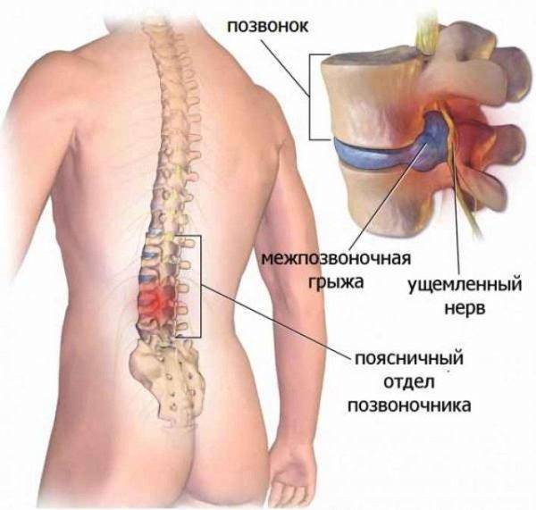 Чем вызвана длительная боль в спине, что делать с межпозвоночной грыжей? врачи ответили на вопросы