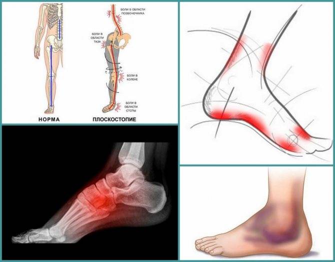 Правильная физкультура при артрозе коленного сустава - нолтрекс.