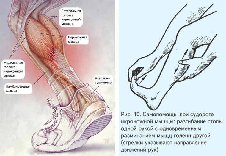 Судороги в ногах: причины, профилактика, что делать, как лечить