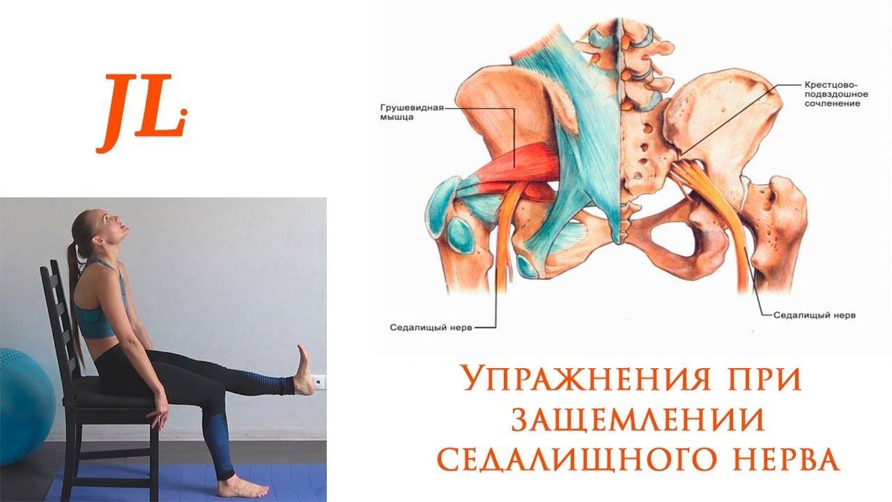 Лфк (лечебная гимнастика) при неврите и невралгии седалищного нерва (ишиас): защемление, воспаление