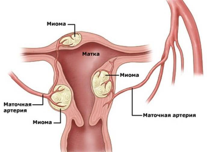 Рак эндометрия матки: признаки, узи-диагностика, прогноз