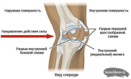 Боль в колене: подсечка от болезни